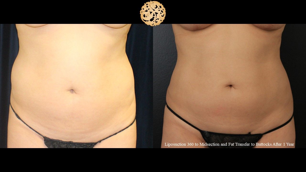 Liposuction Trunk Before & After