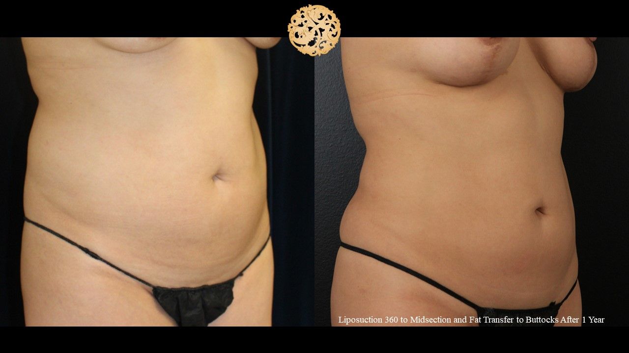 Liposuction Trunk Before & After