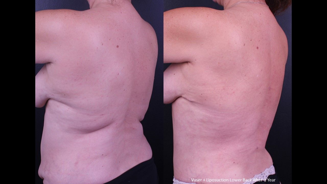 Liposuction Trunk Before & After