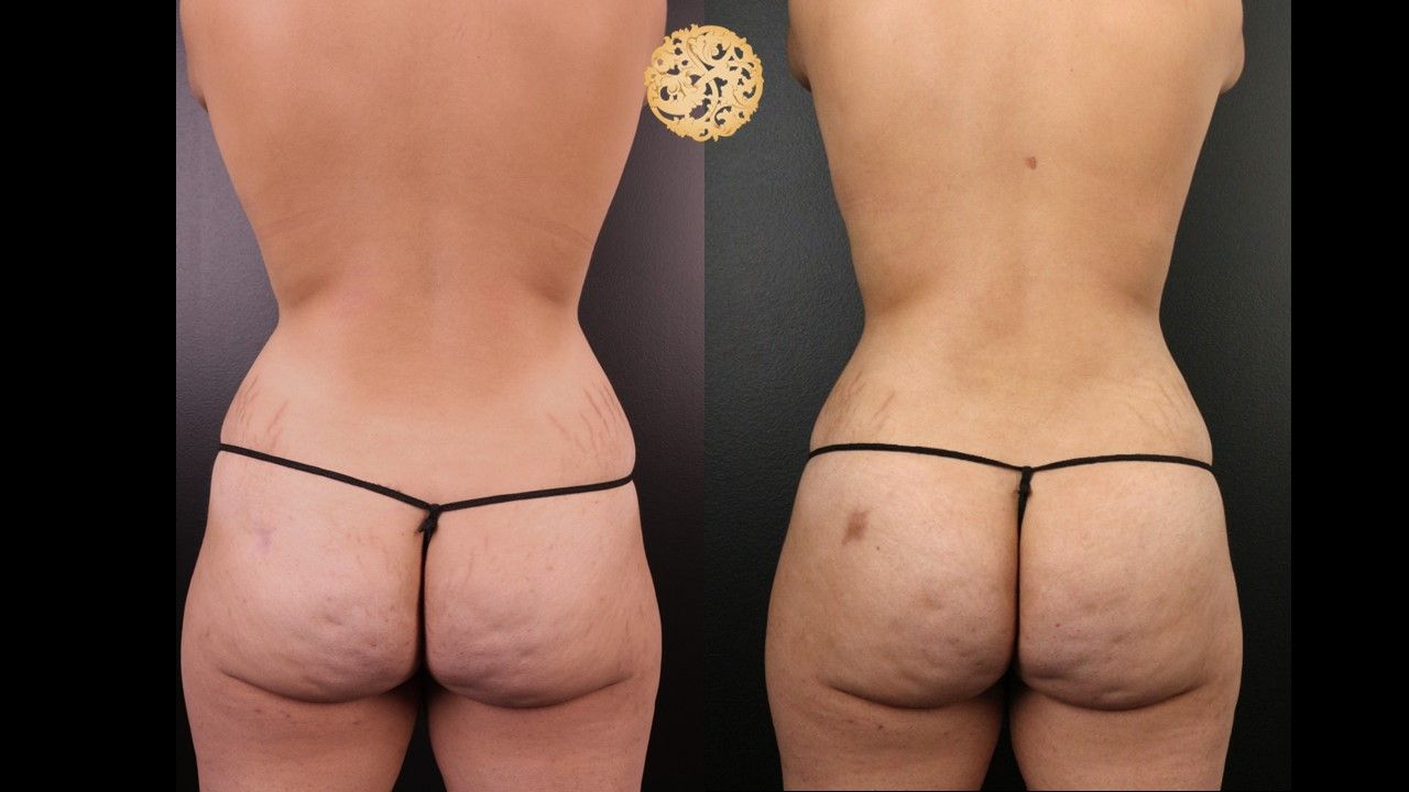 Liposuction Trunk Before & After