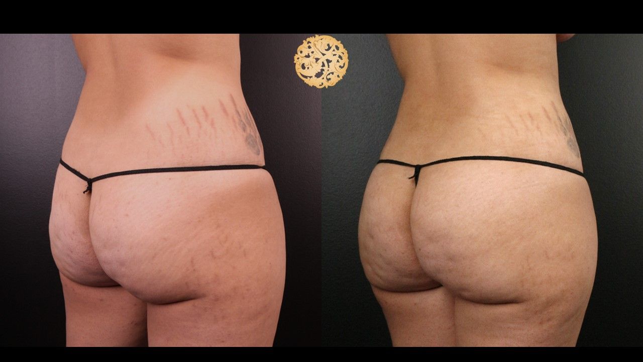 Liposuction Trunk Before & After
