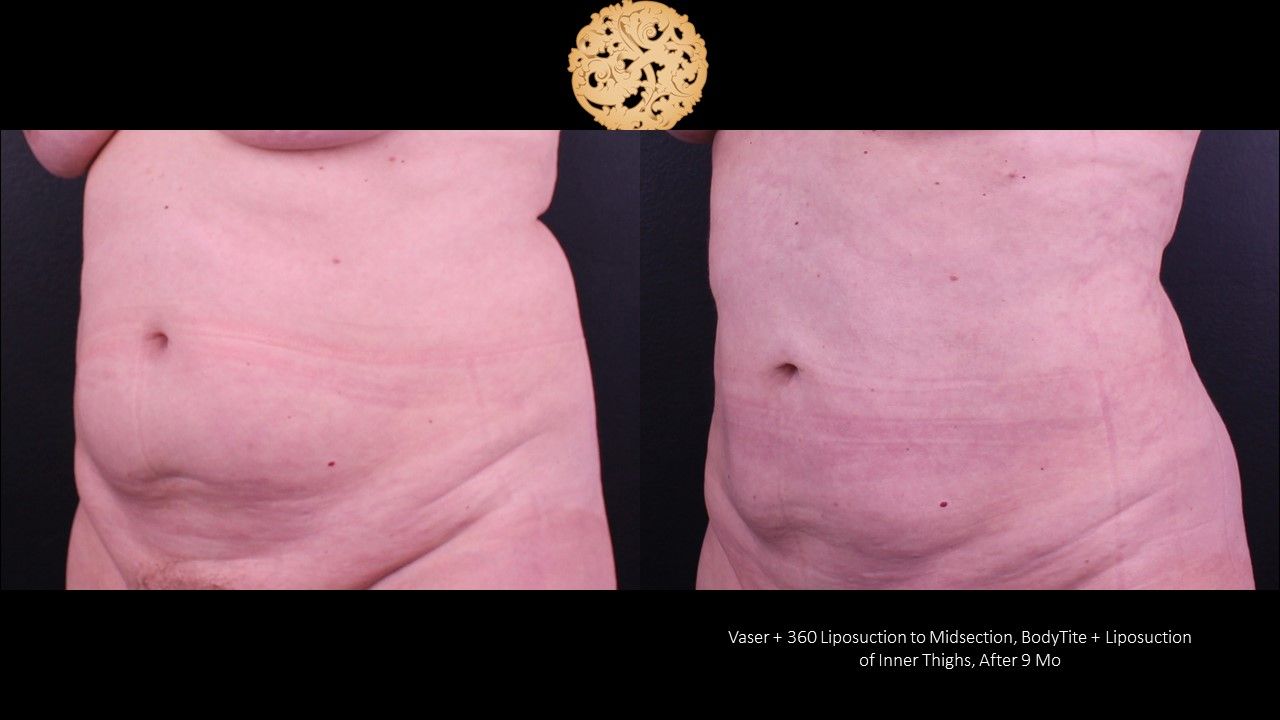 Liposuction Trunk Before & After