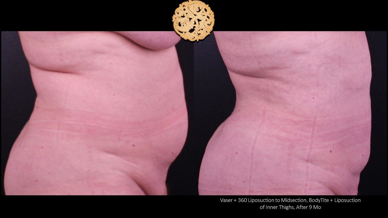 Liposuction Trunk Before & After