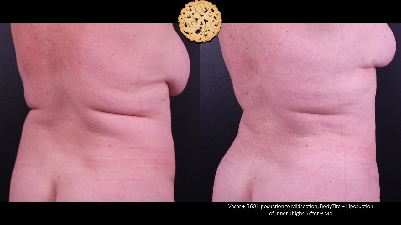 Liposuction Trunk Before & After