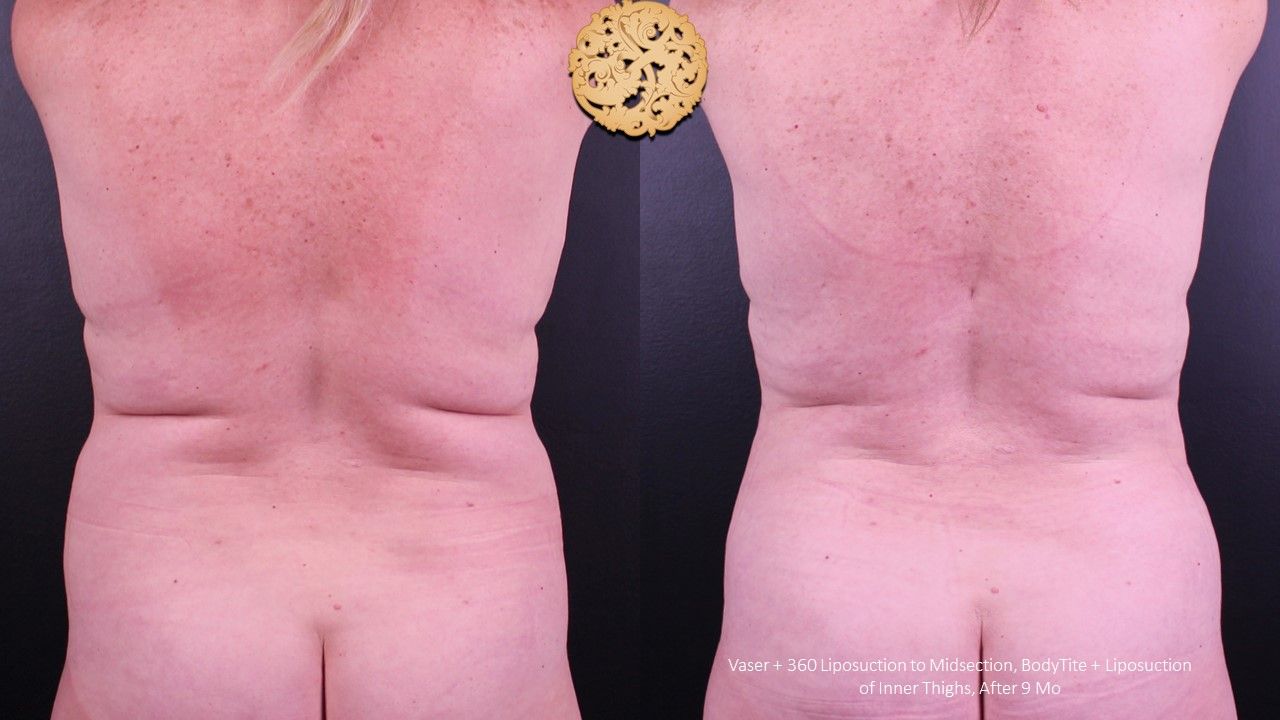 Liposuction Trunk Before & After