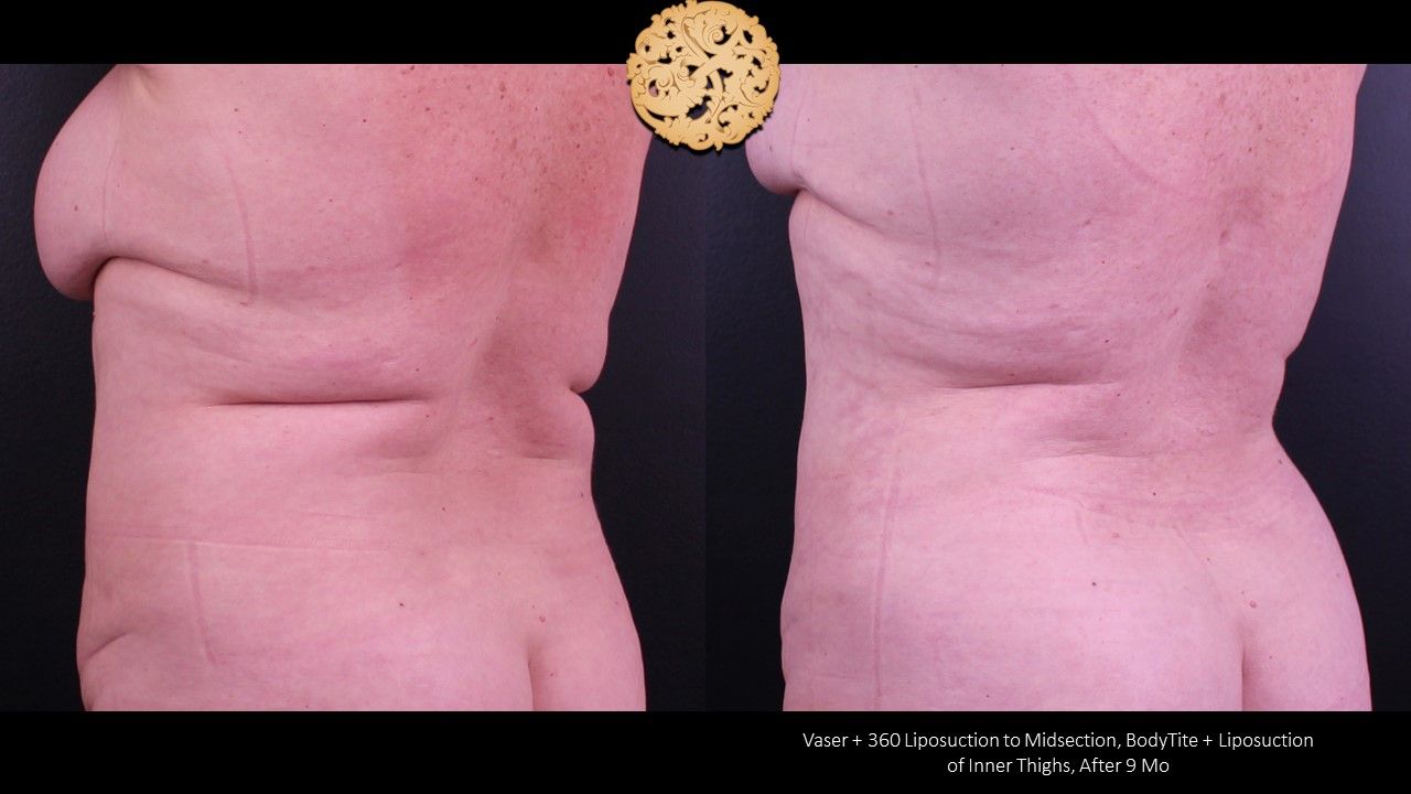 Liposuction Trunk Before & After