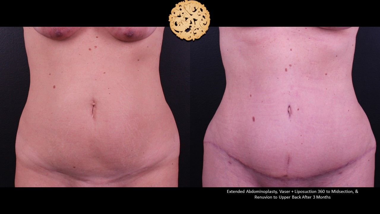 Liposuction Trunk Before & After