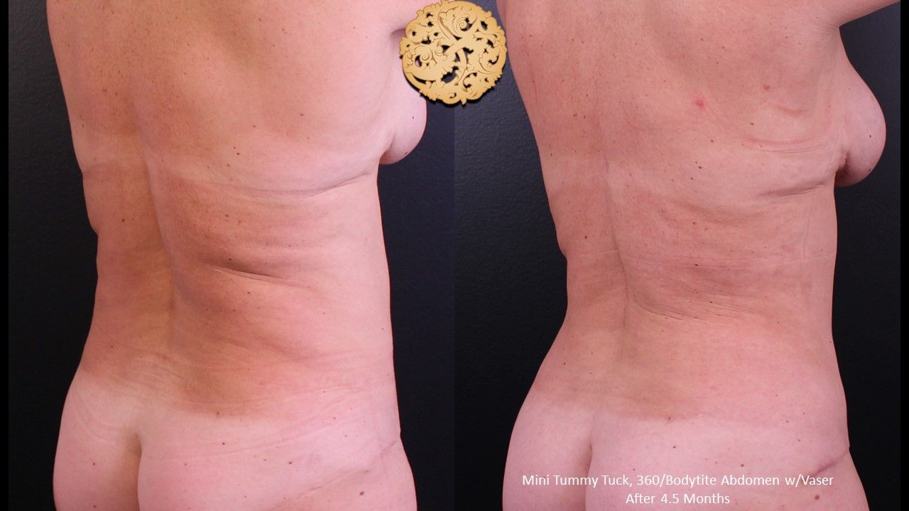 Liposuction Trunk Before & After