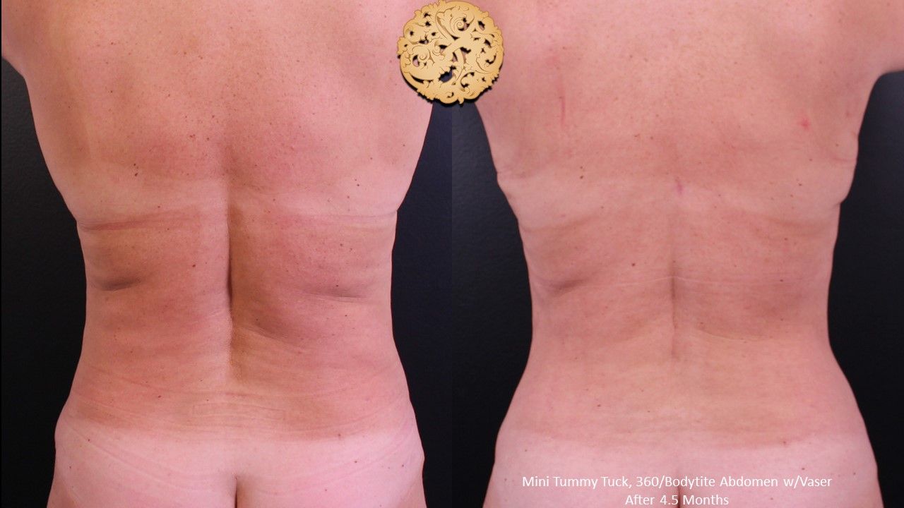 Liposuction Trunk Before & After