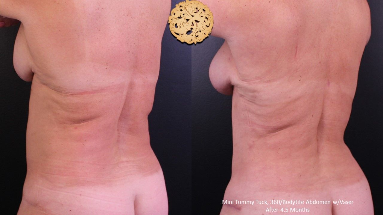Liposuction Trunk Before & After