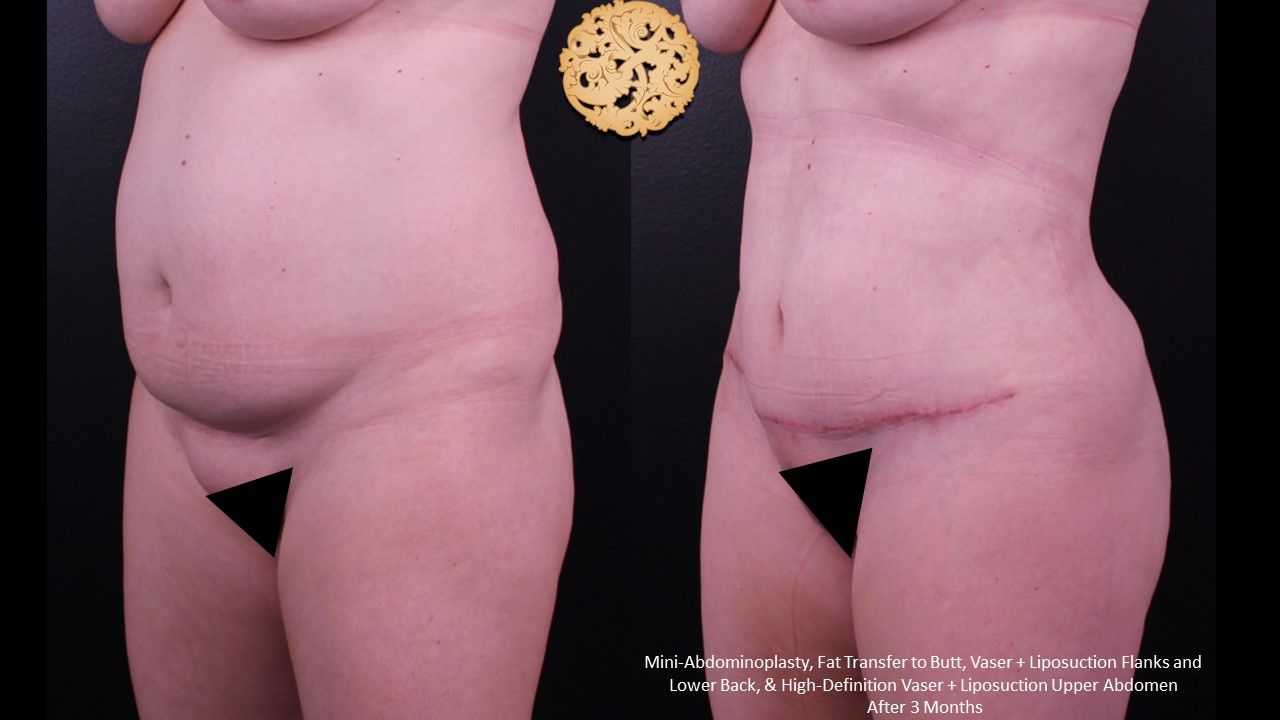 Liposuction Trunk Before & After