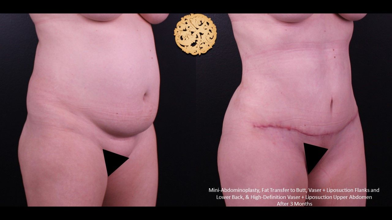 Liposuction Trunk Before & After