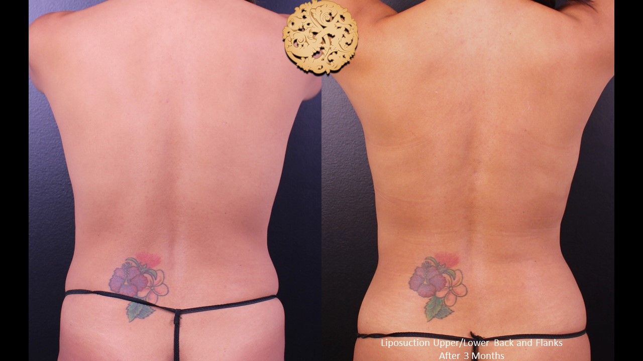 Liposuction Trunk Before & After
