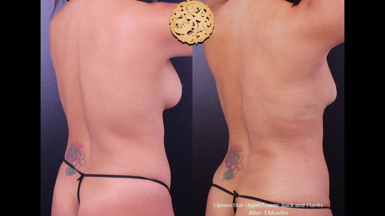 Liposuction Trunk Before & After