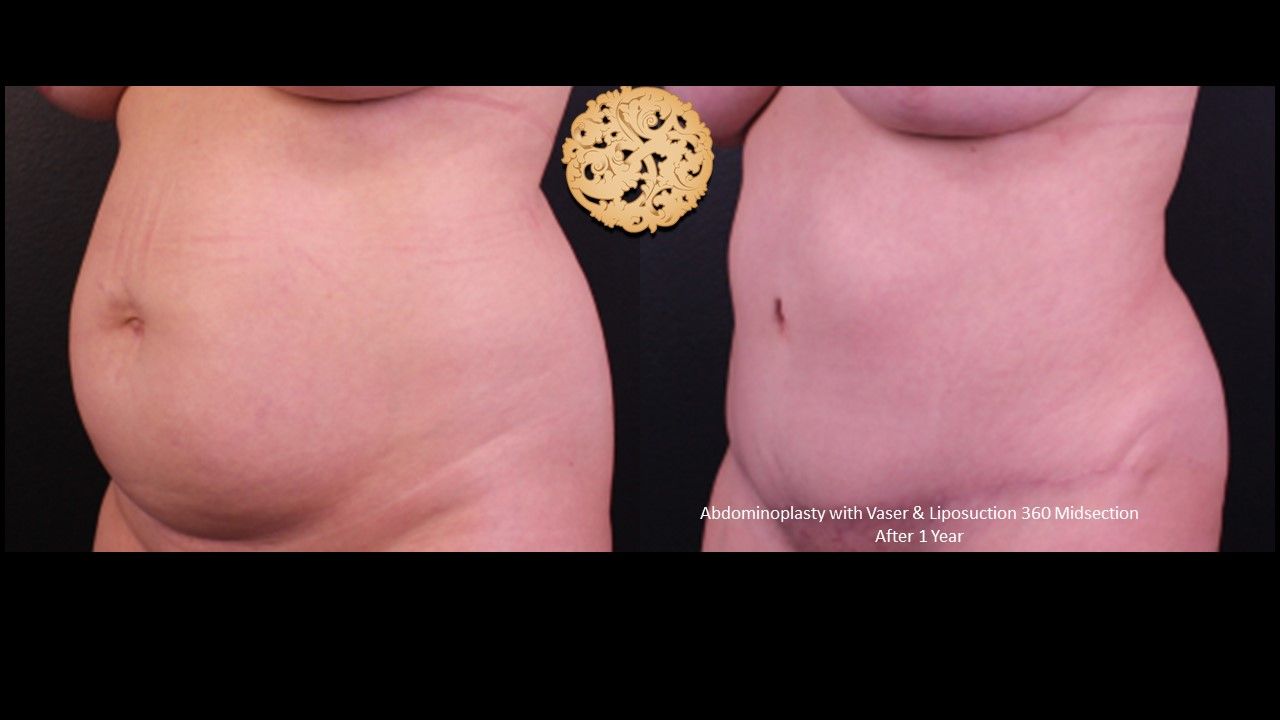 Liposuction Trunk Before & After