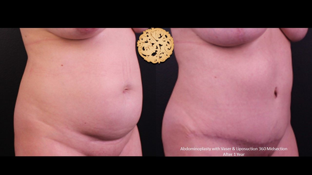 Liposuction Trunk Before & After