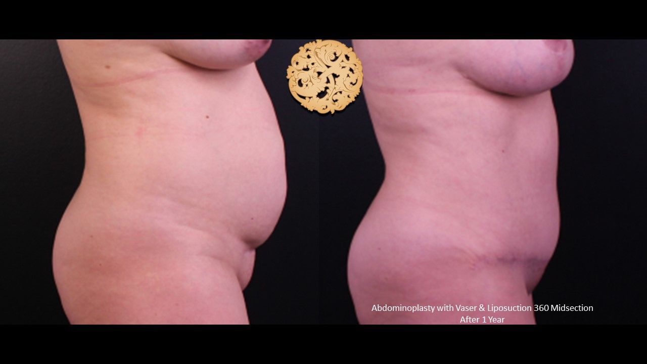 Liposuction Trunk Before & After