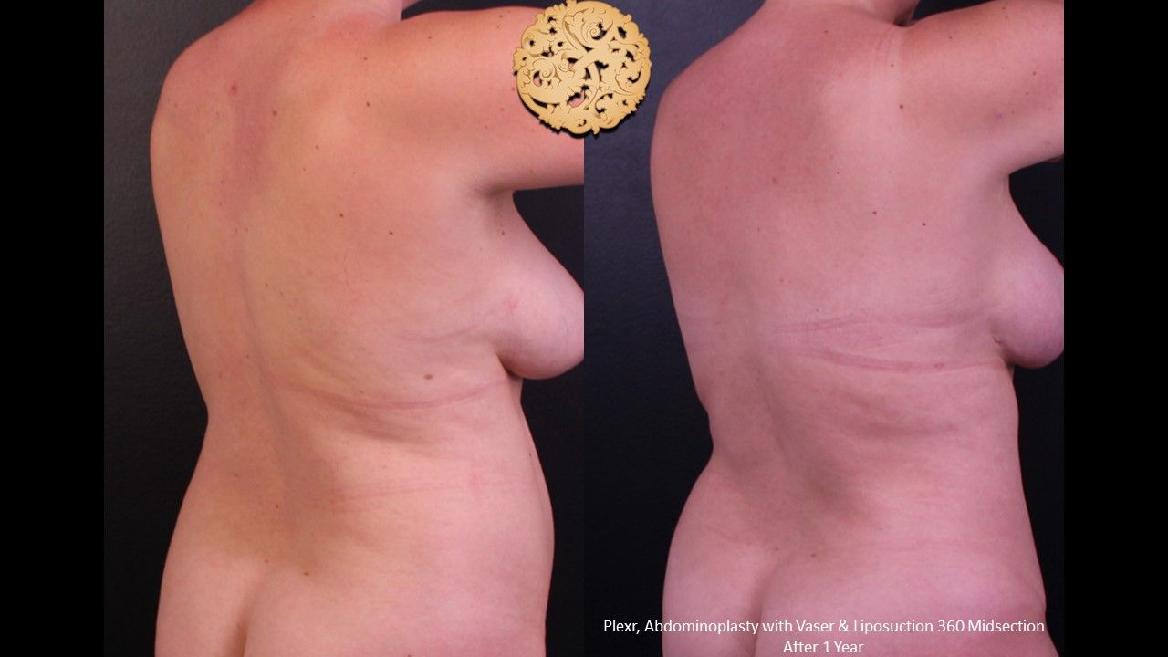 Liposuction Trunk Before & After