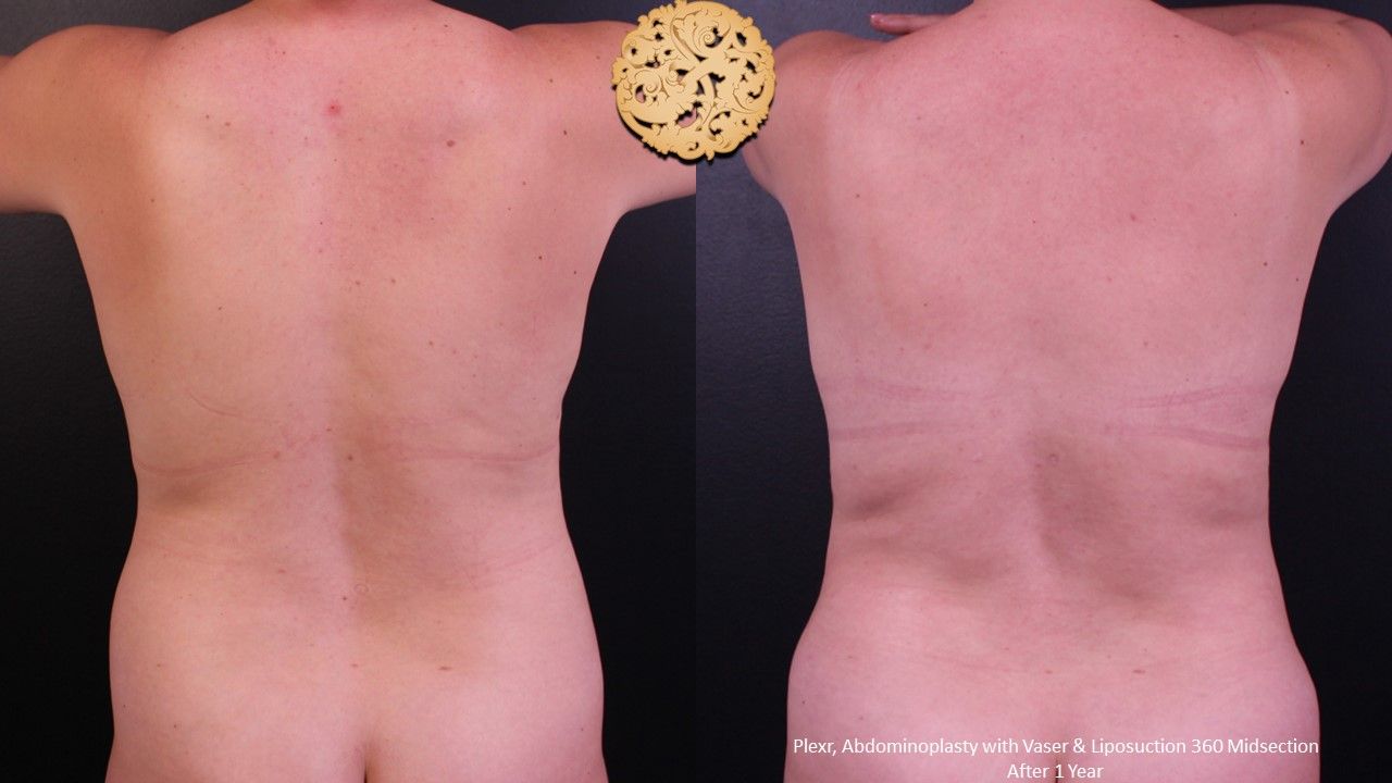 Liposuction Trunk Before & After