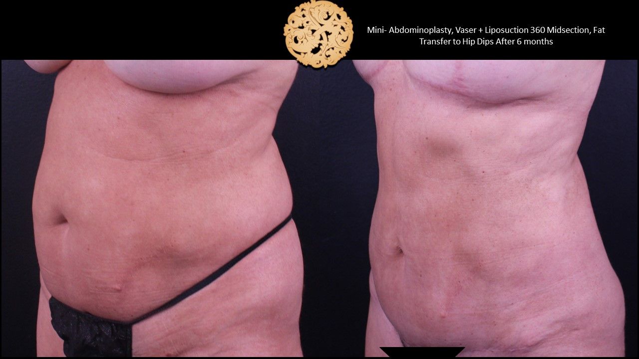 Liposuction Trunk Before & After