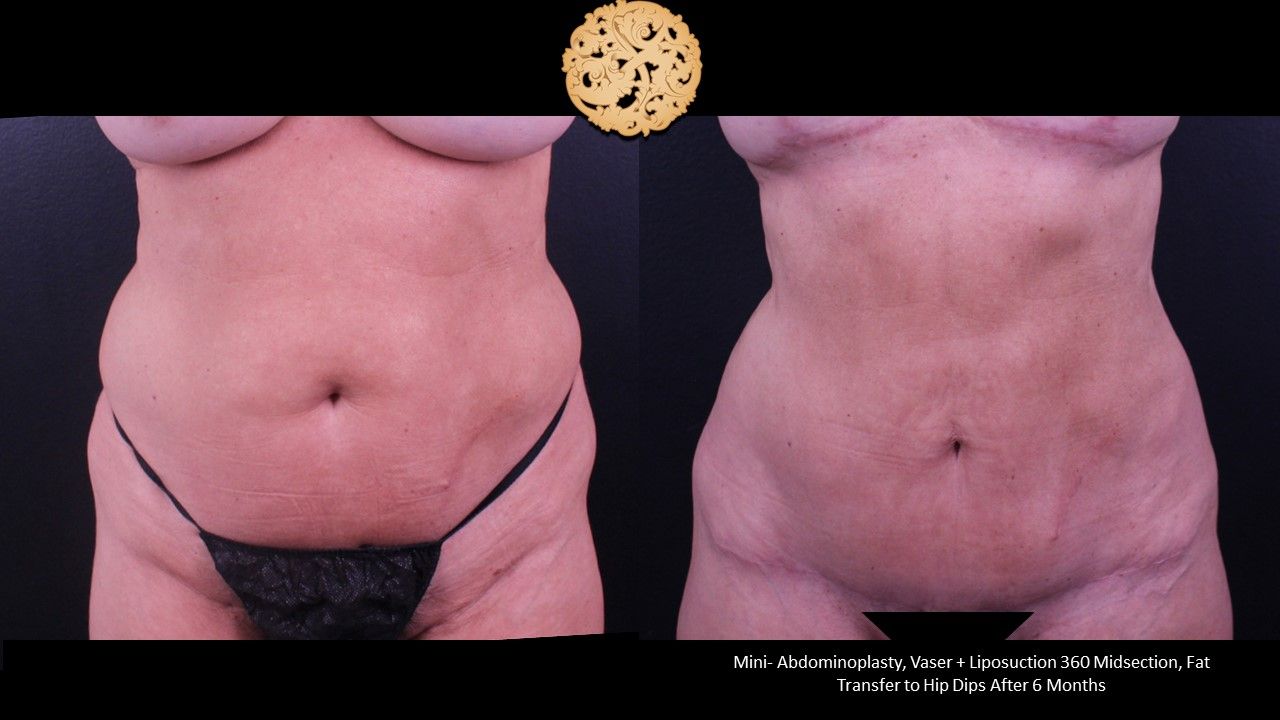 Liposuction Trunk Before & After