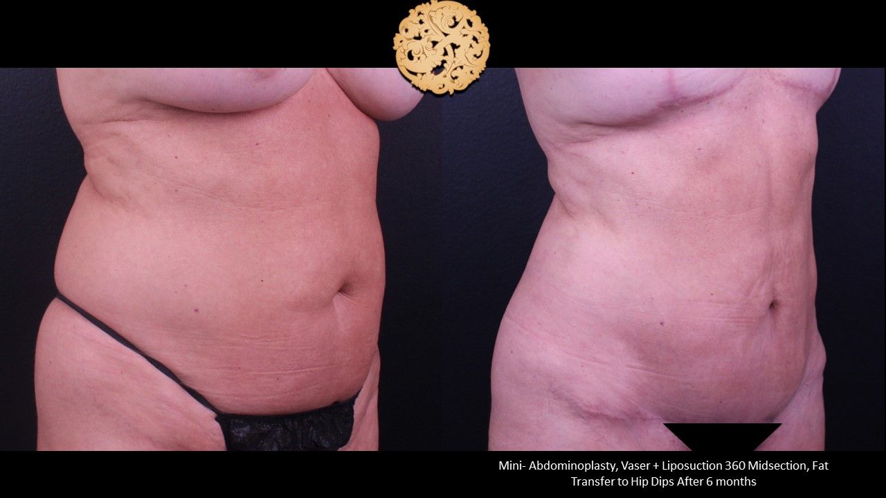 Liposuction Trunk Before & After