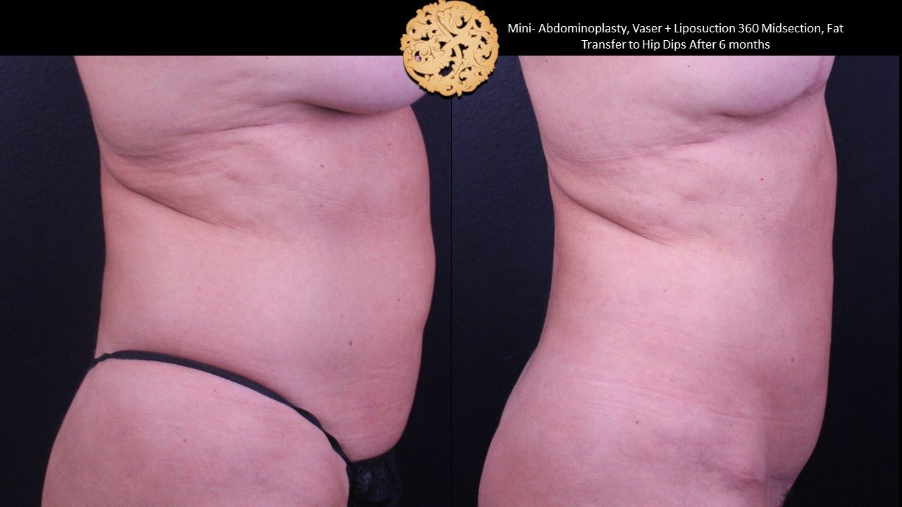 Liposuction Trunk Before & After