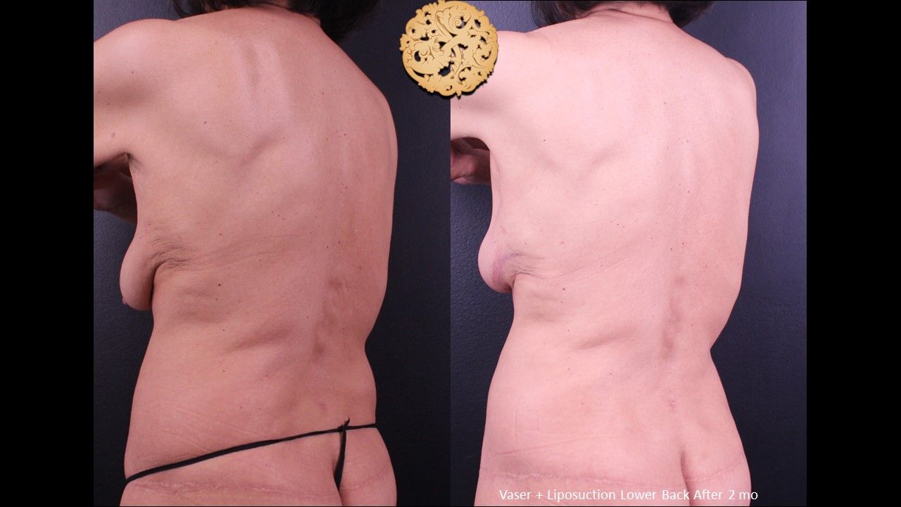 Liposuction Trunk Before & After