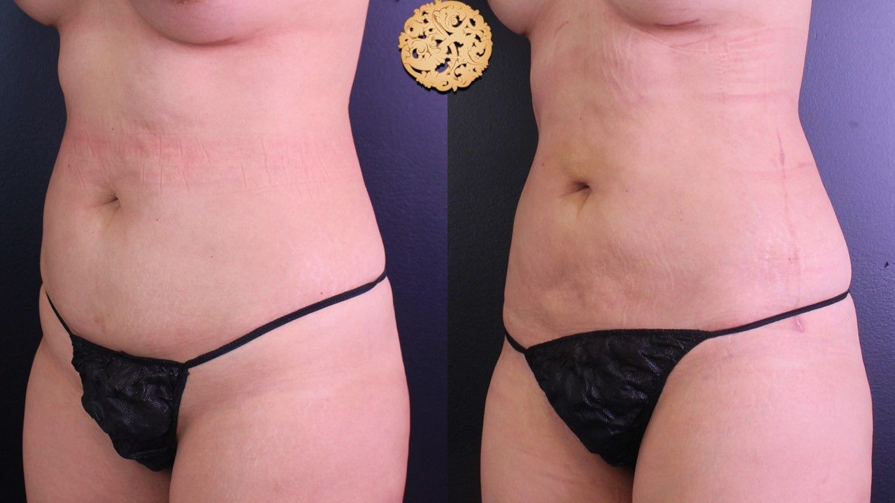 Liposuction Trunk Before & After
