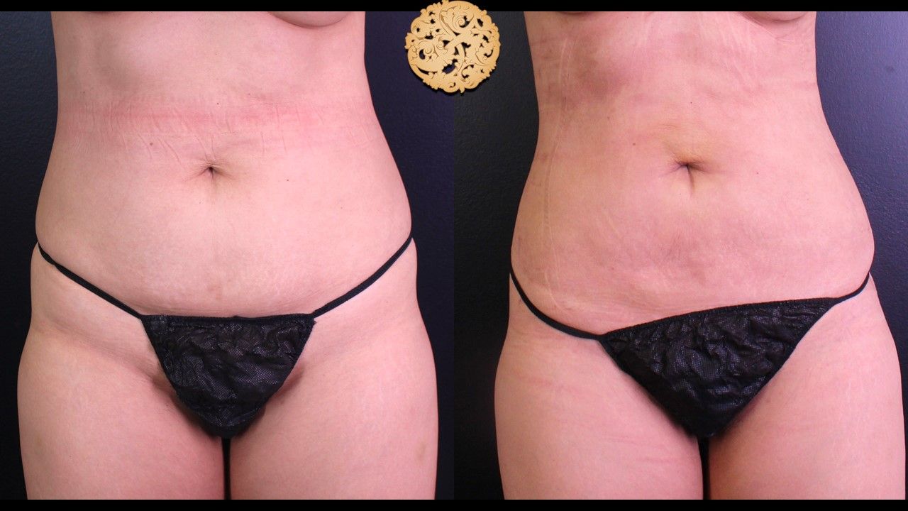 Liposuction Trunk Before & After