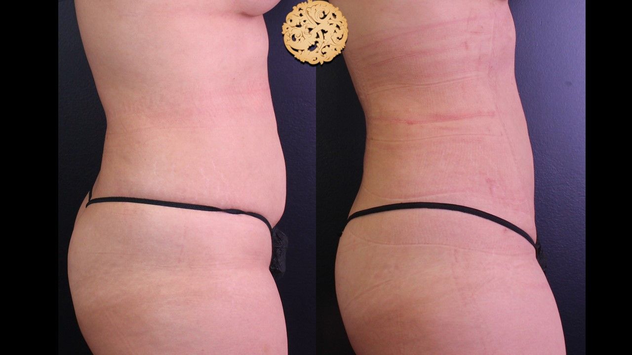 Liposuction Trunk Before & After