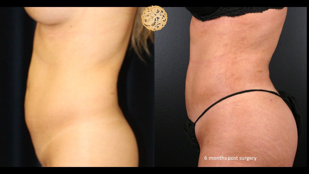 Liposuction Trunk Before & After