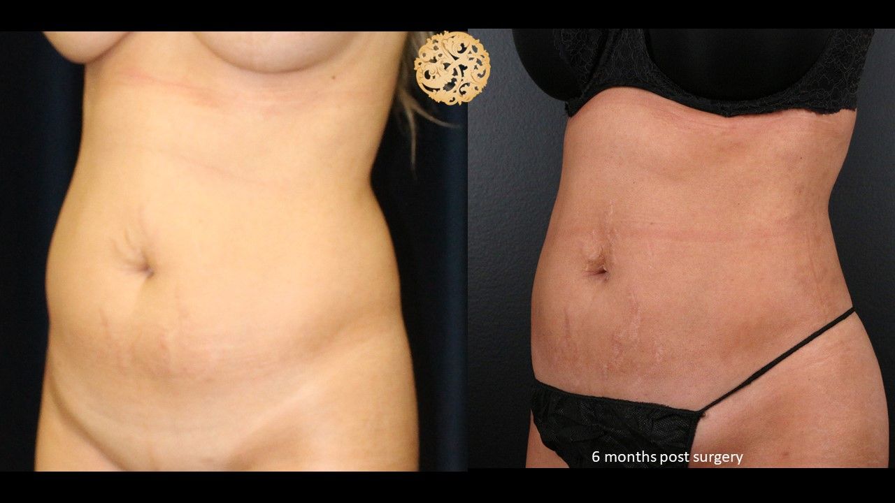 Liposuction Trunk Before & After