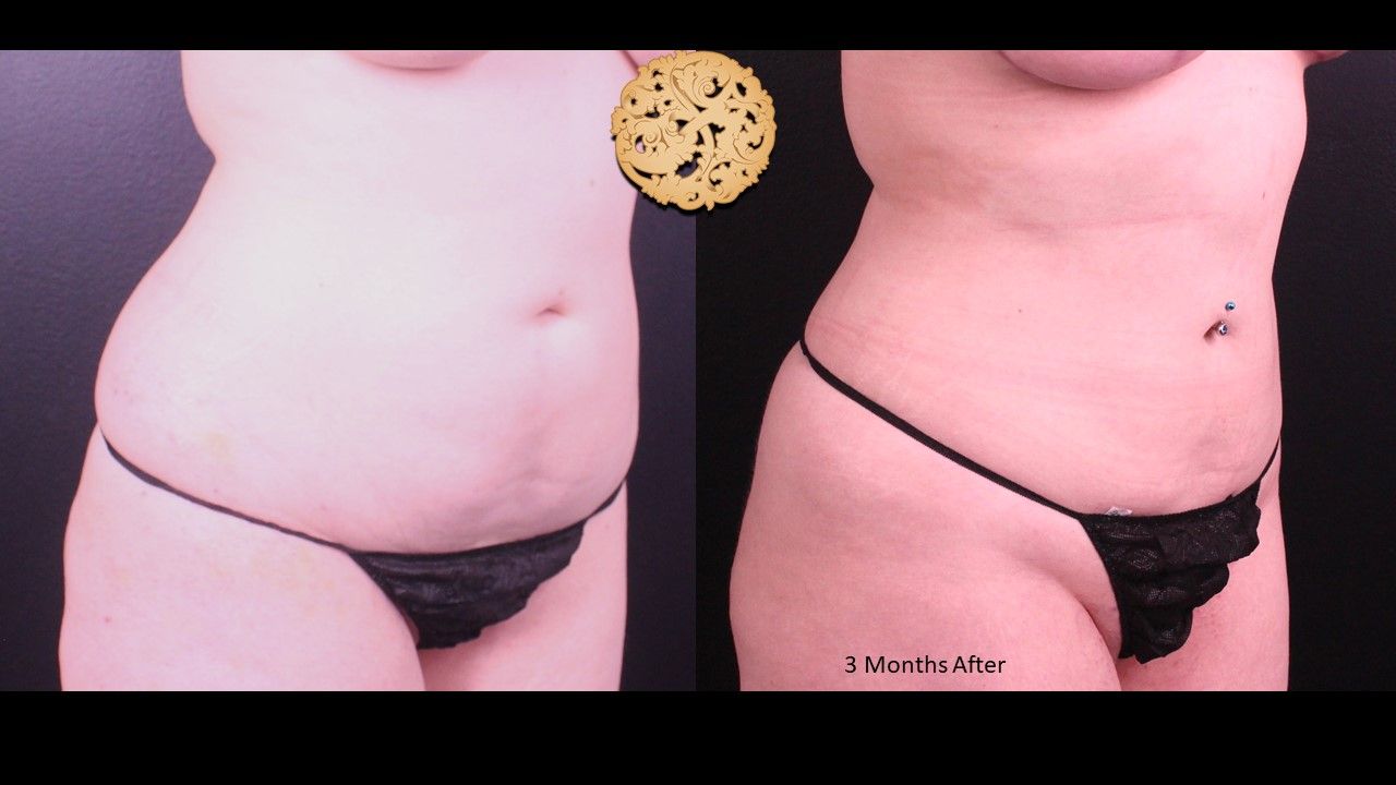 Liposuction Trunk Before & After