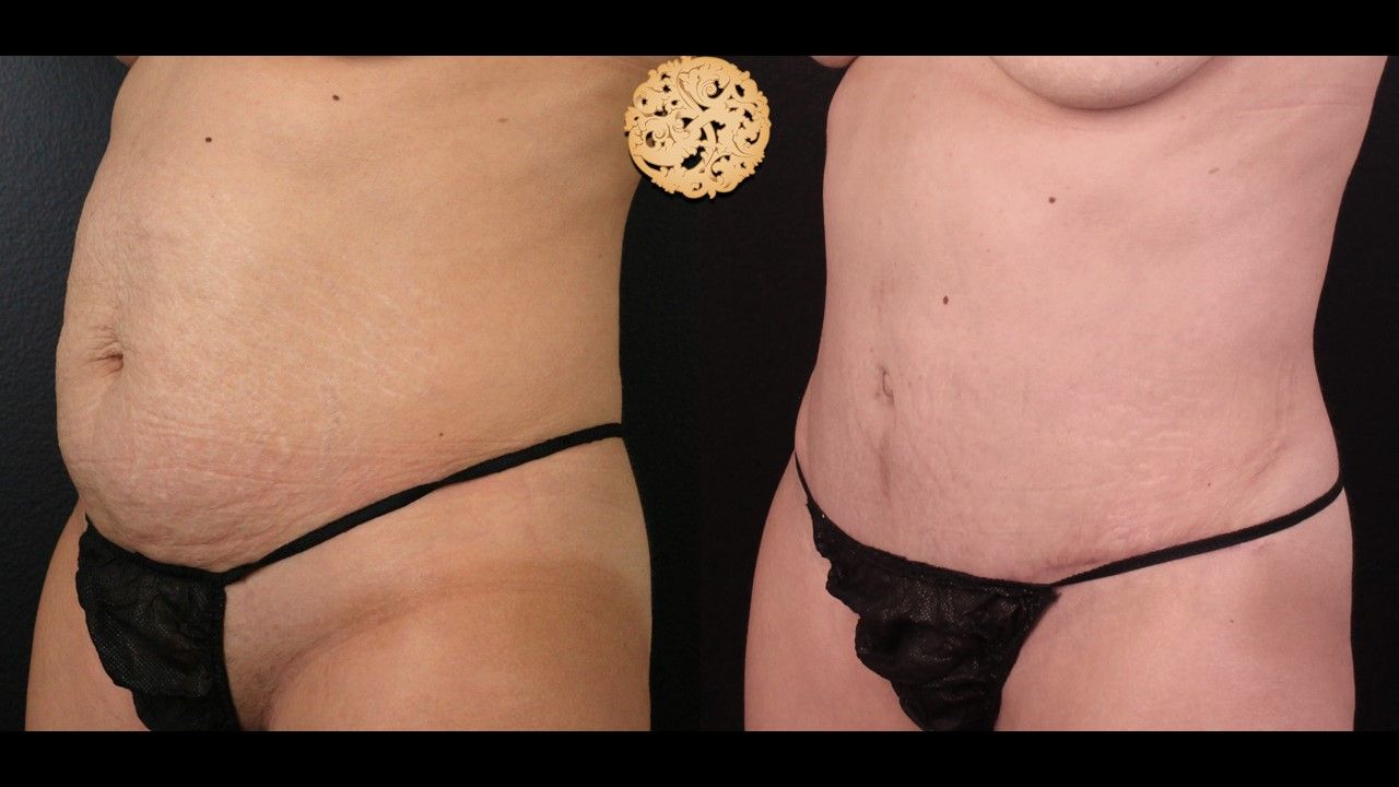 Liposuction Trunk Before & After