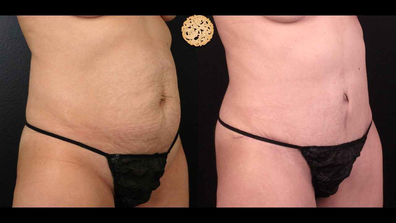Liposuction Trunk Before & After