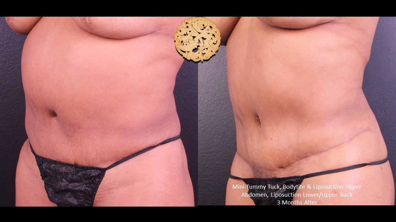 Liposuction Trunk Before & After