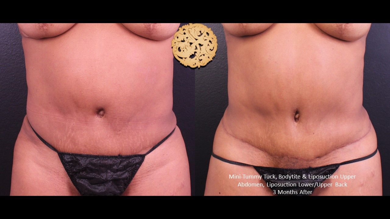 Liposuction Trunk Before & After