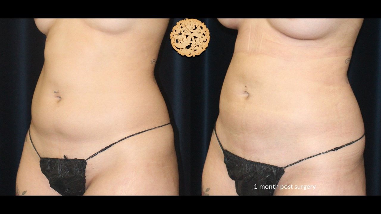 Liposuction Trunk Before & After
