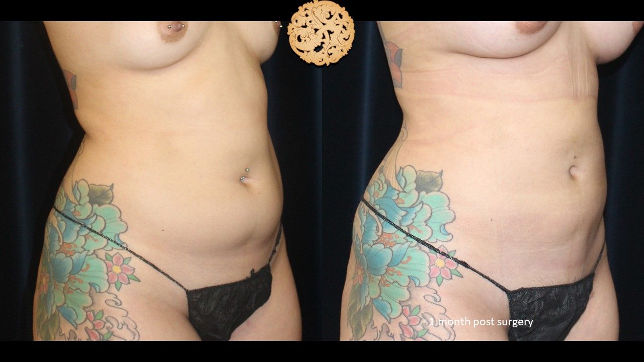 Liposuction Trunk Before & After