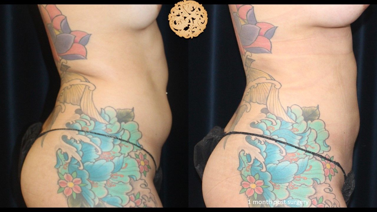 Liposuction Trunk Before & After