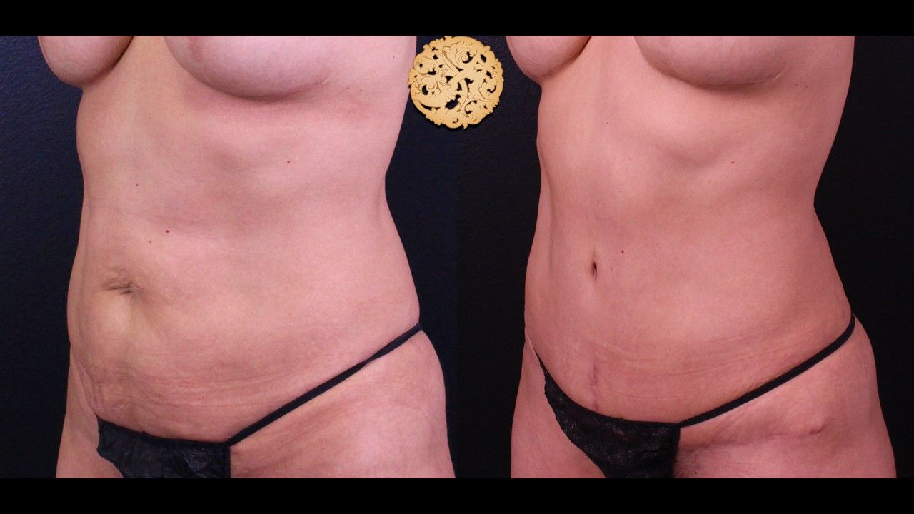 Liposuction Trunk Before & After