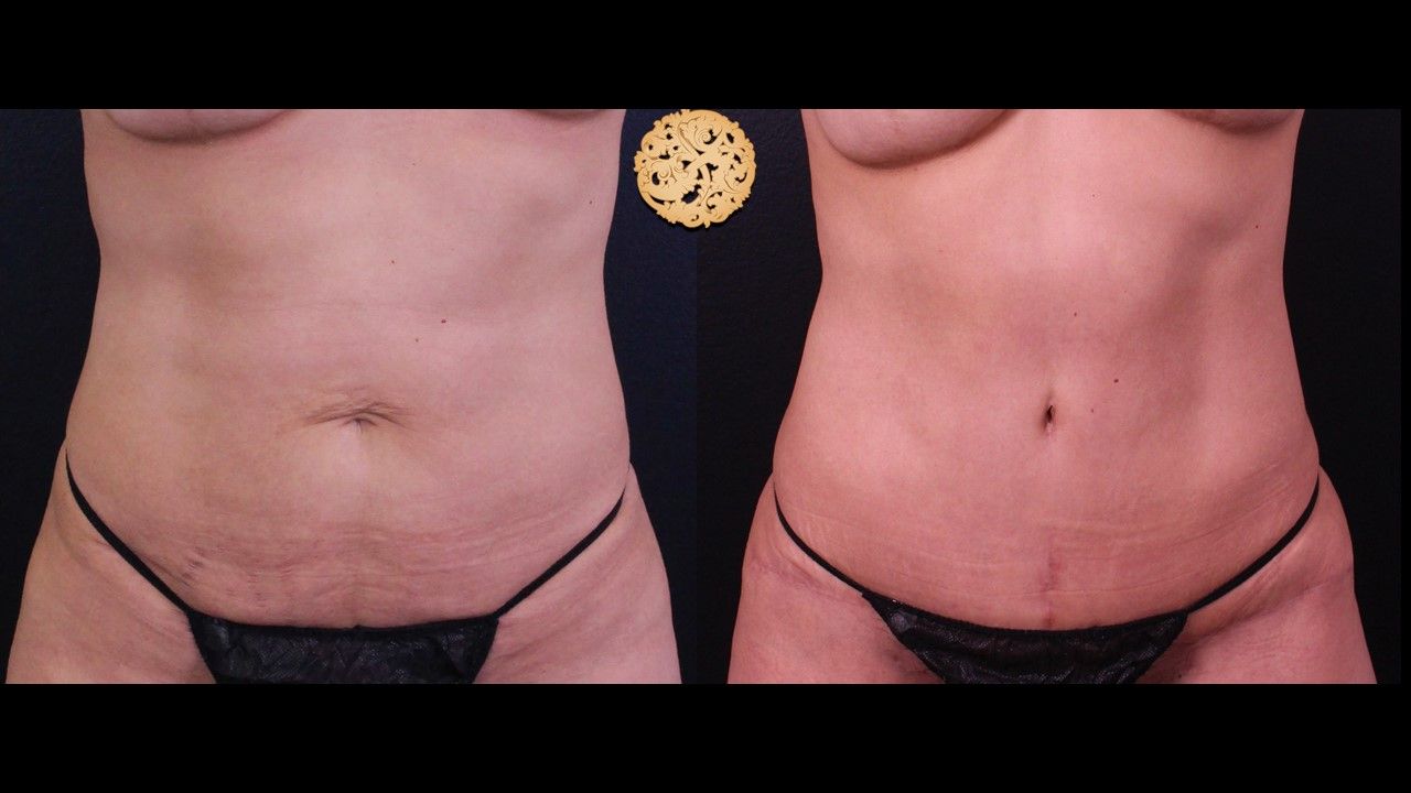 Liposuction Trunk Before & After