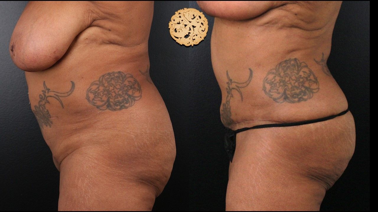 Liposuction Trunk Before & After