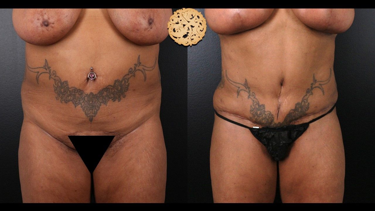 Liposuction Trunk Before & After
