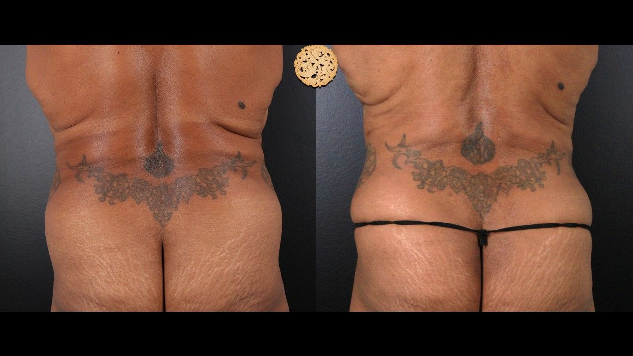 Liposuction Trunk Before & After
