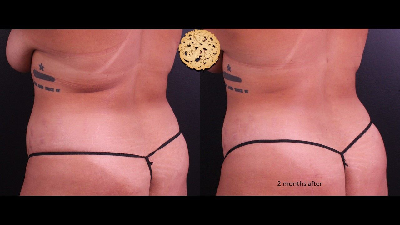 Liposuction Trunk Before & After