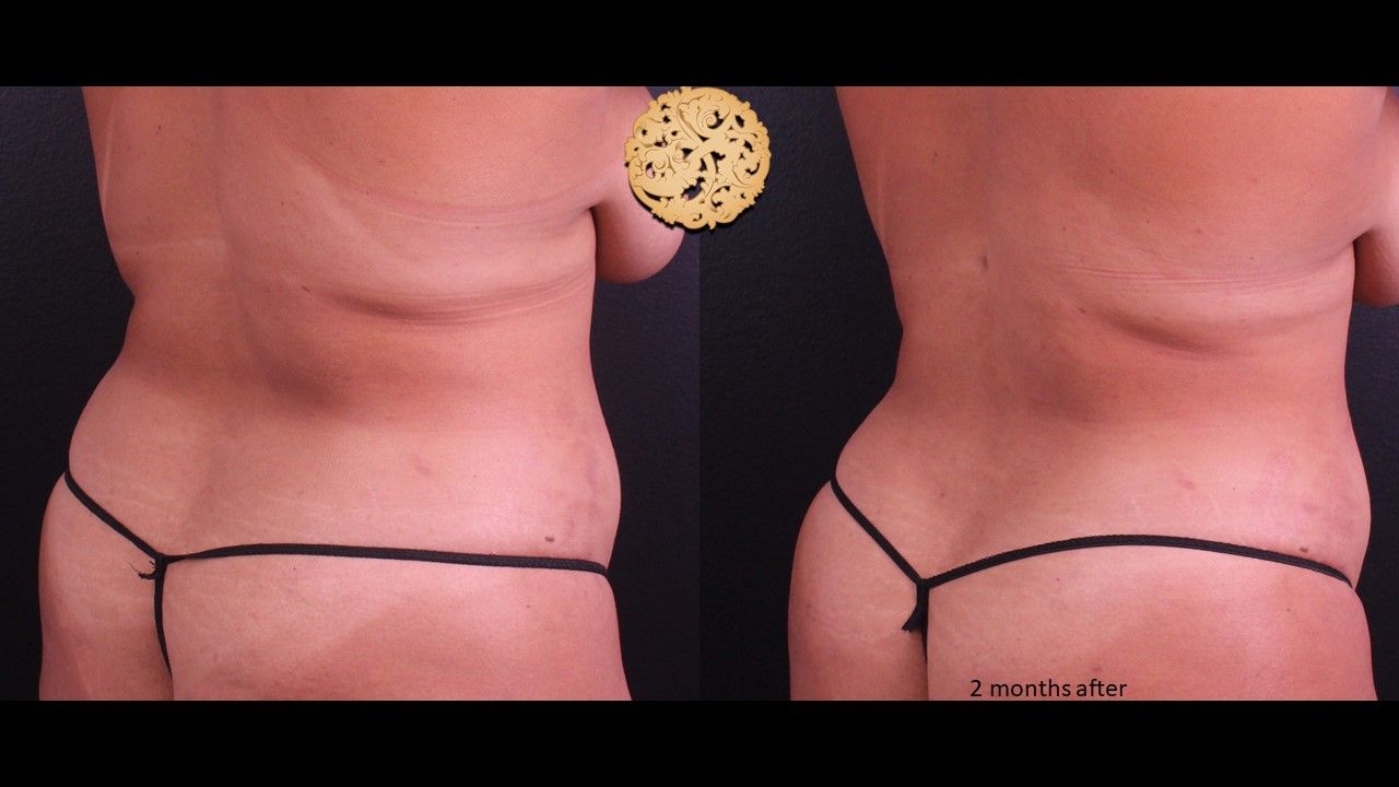 Liposuction Trunk Before & After