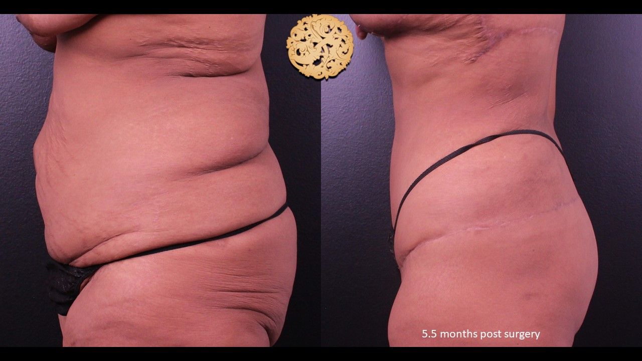 Liposuction Trunk Before & After