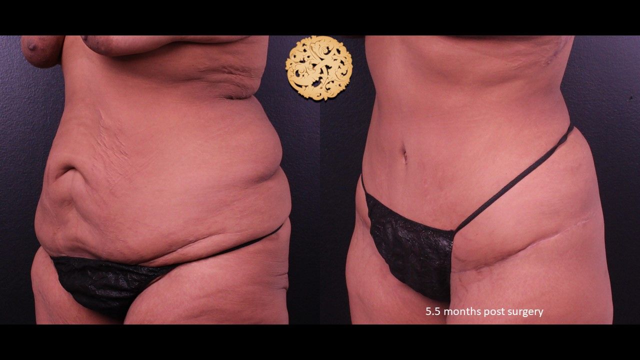 Liposuction Trunk Before & After
